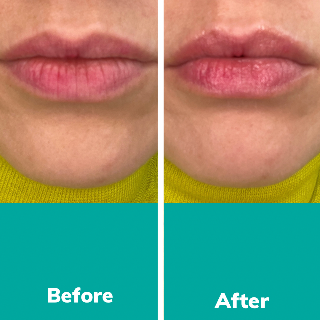 Before using Fitglow Night Lip Serum and After